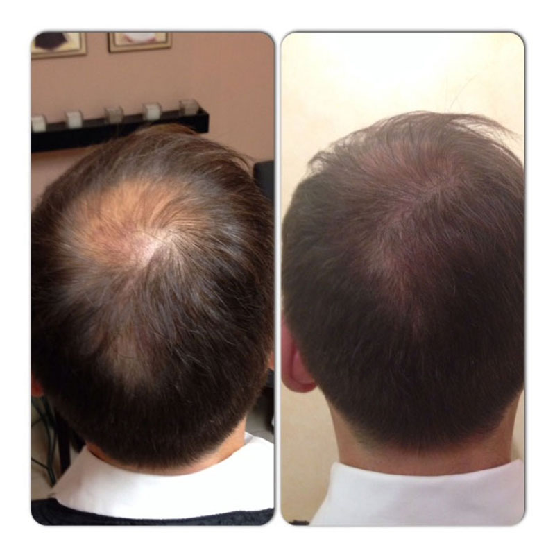 Scalp electrolysis Clearance